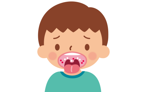 口内炎